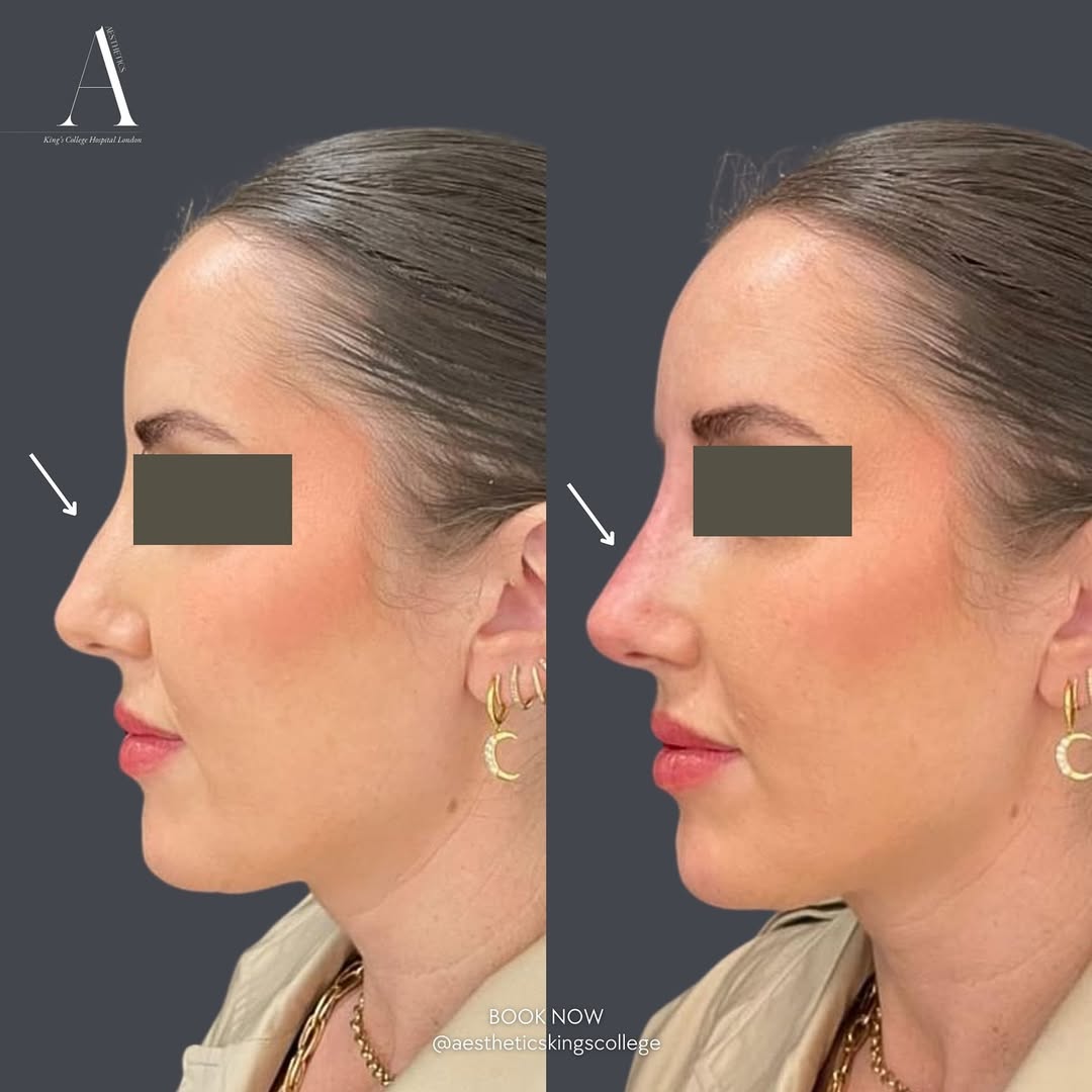 Non-surgical rhinoplasty