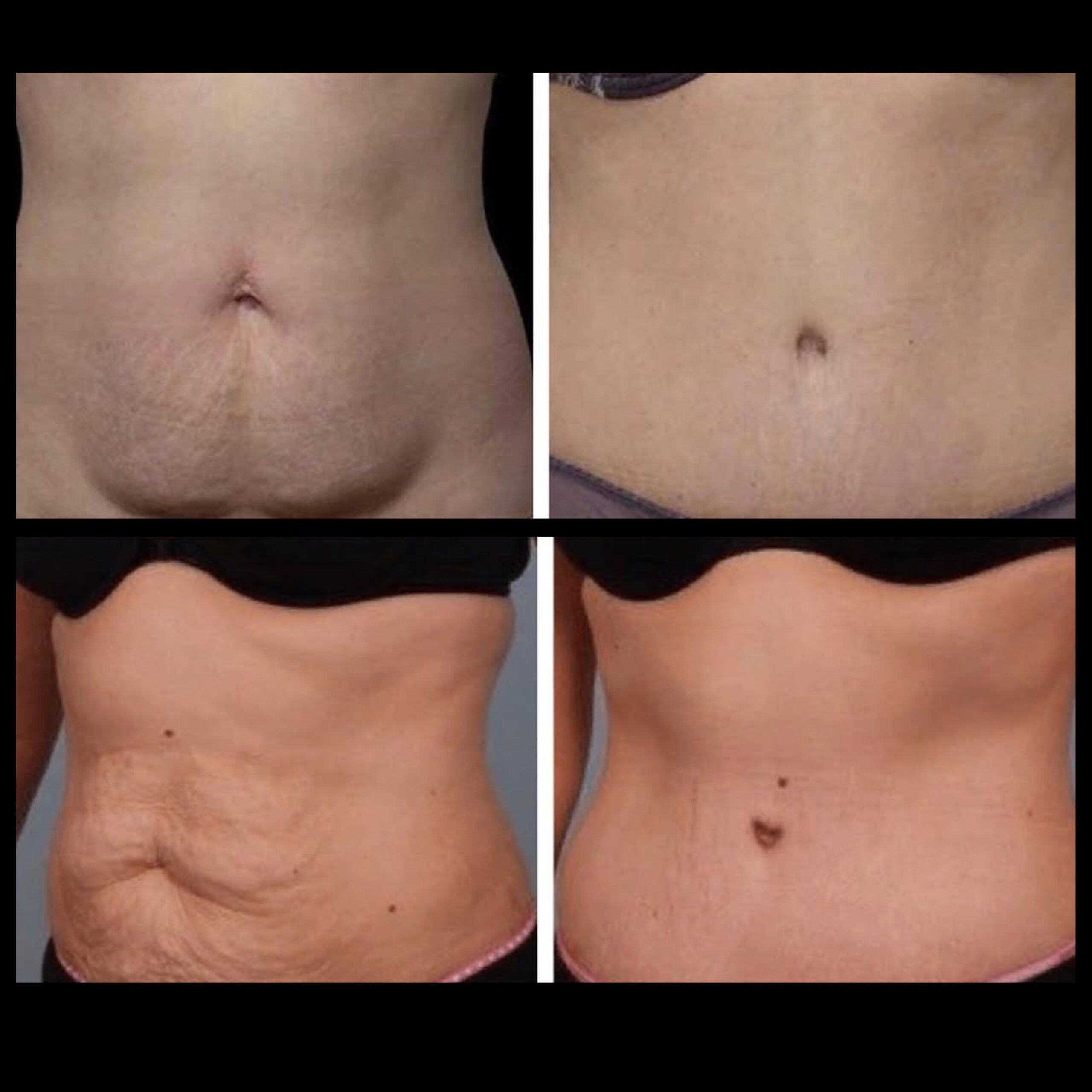 abdominoplasty