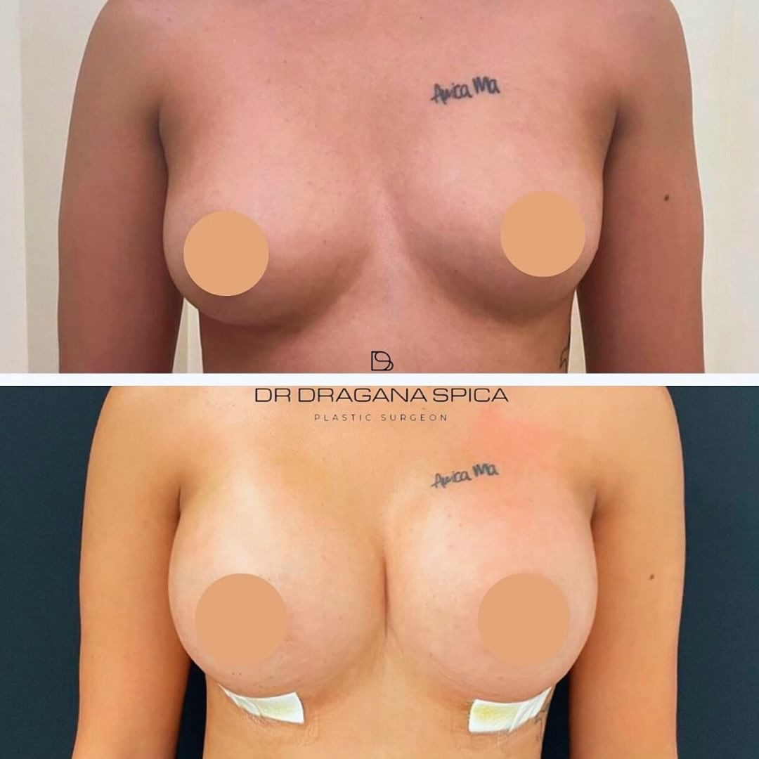 breast augmentation 1