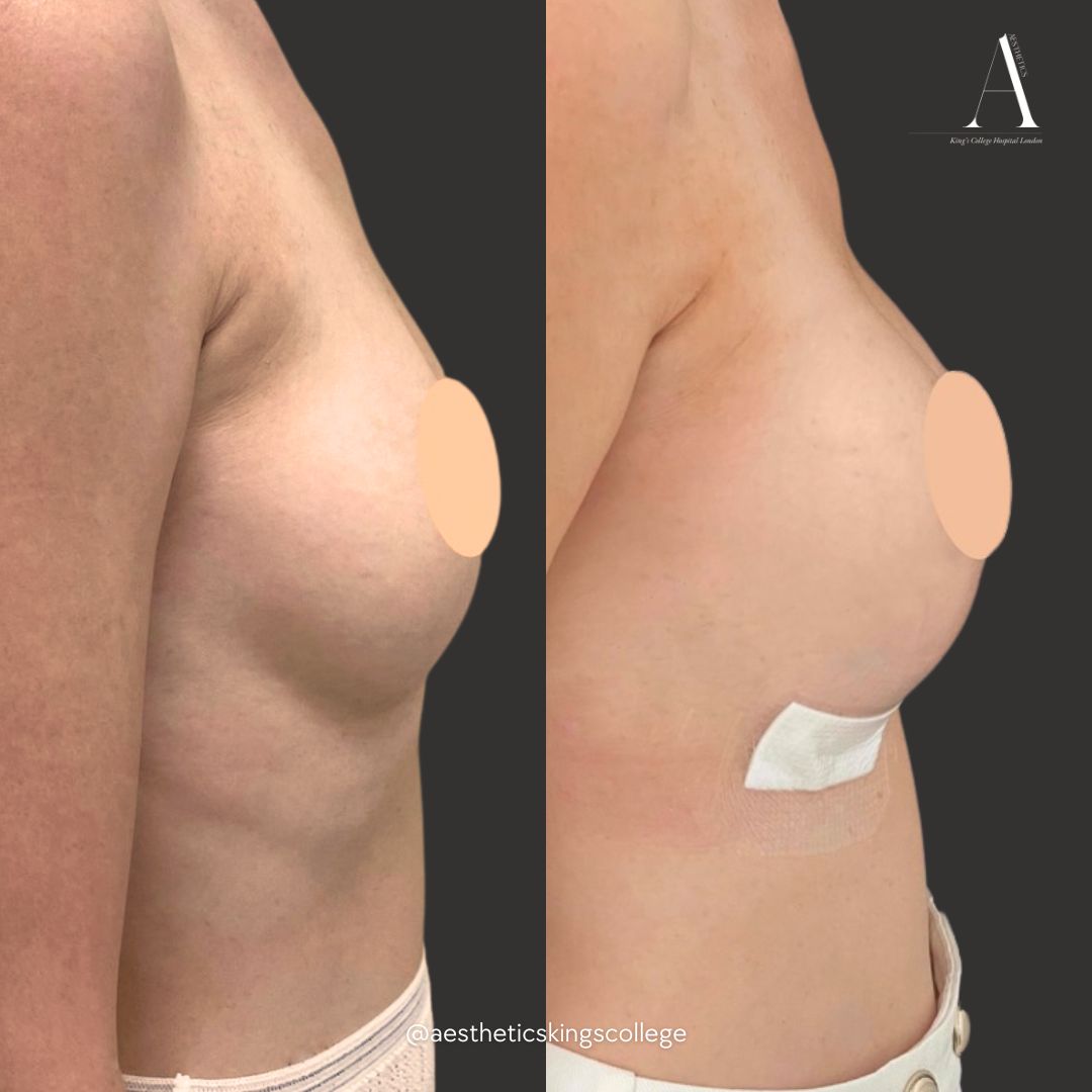 breast augmentation 2