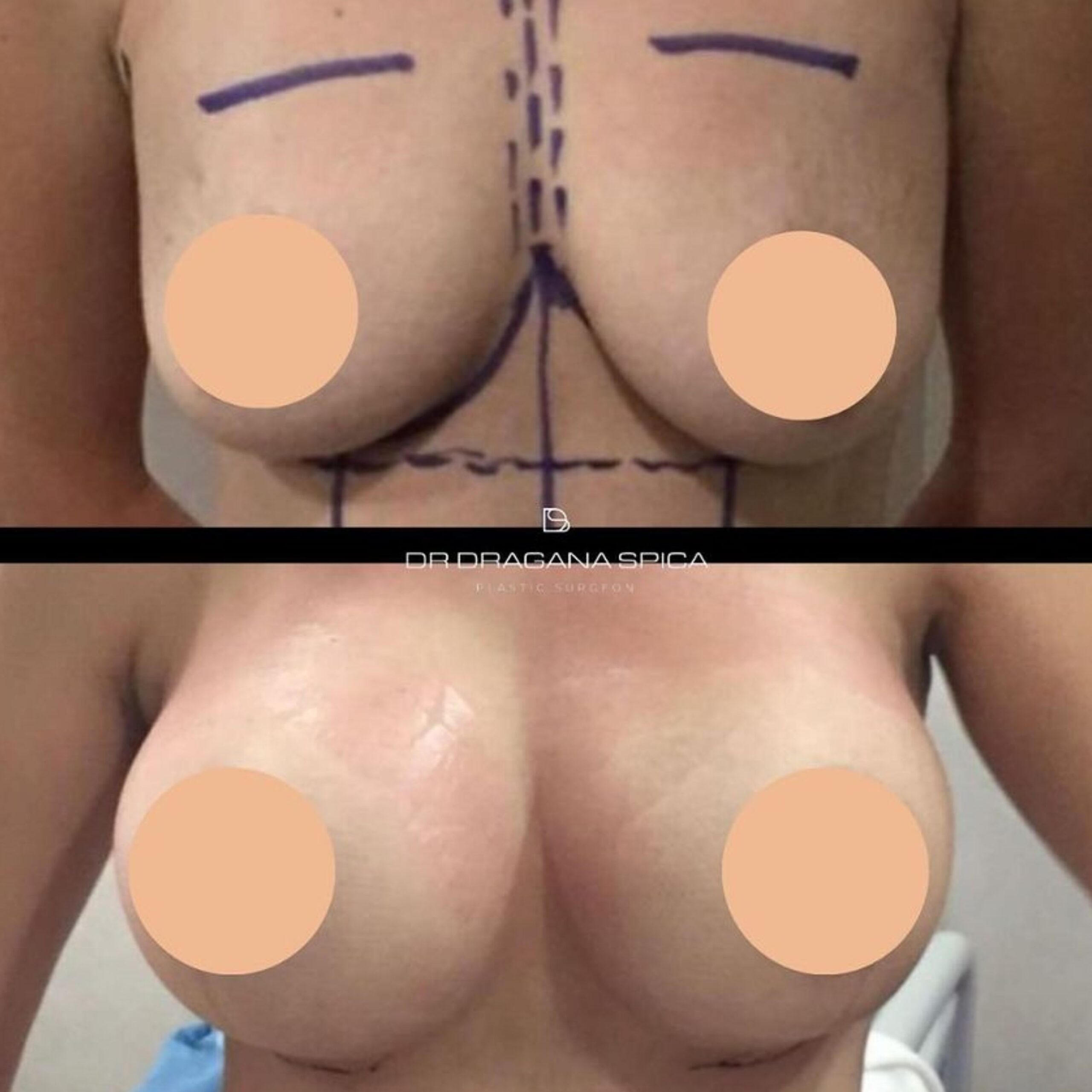 breast augmentation