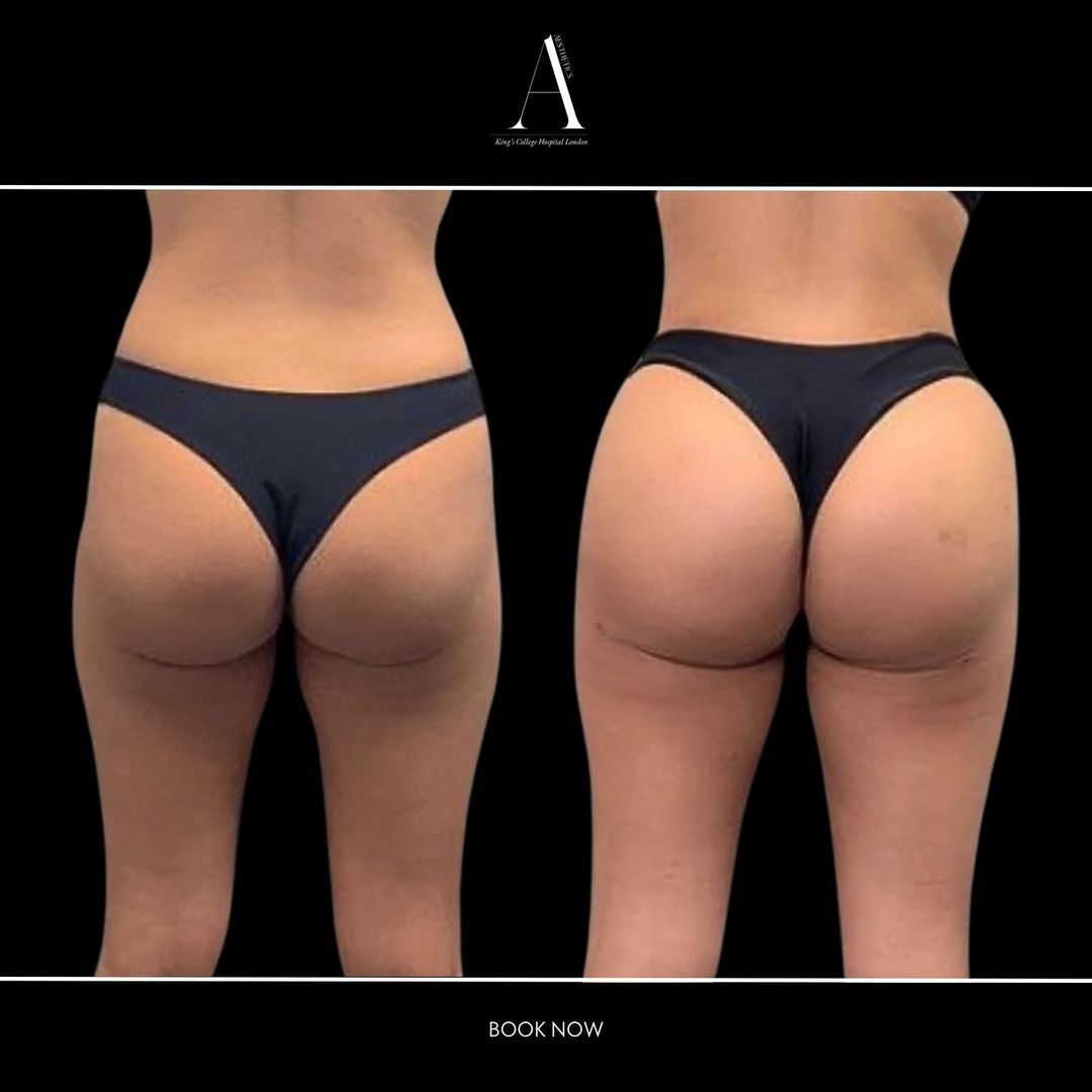 butt augmentation 2