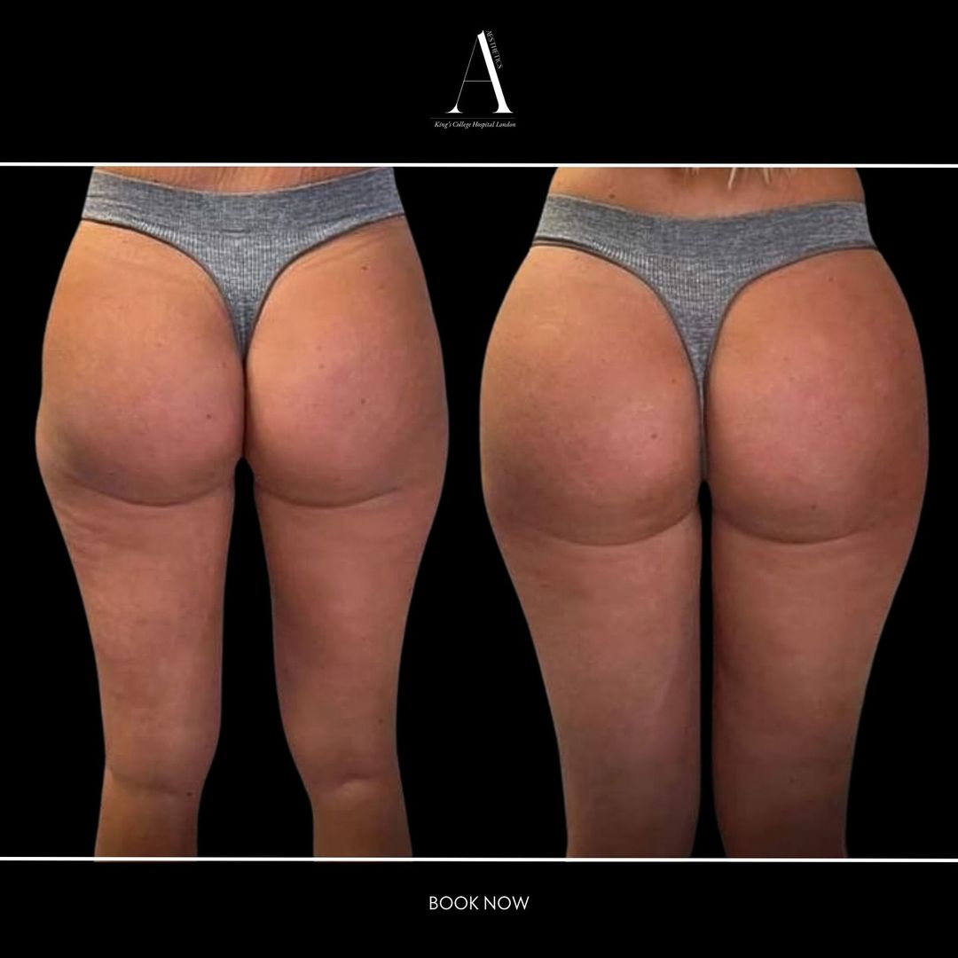 butt augmentation 3