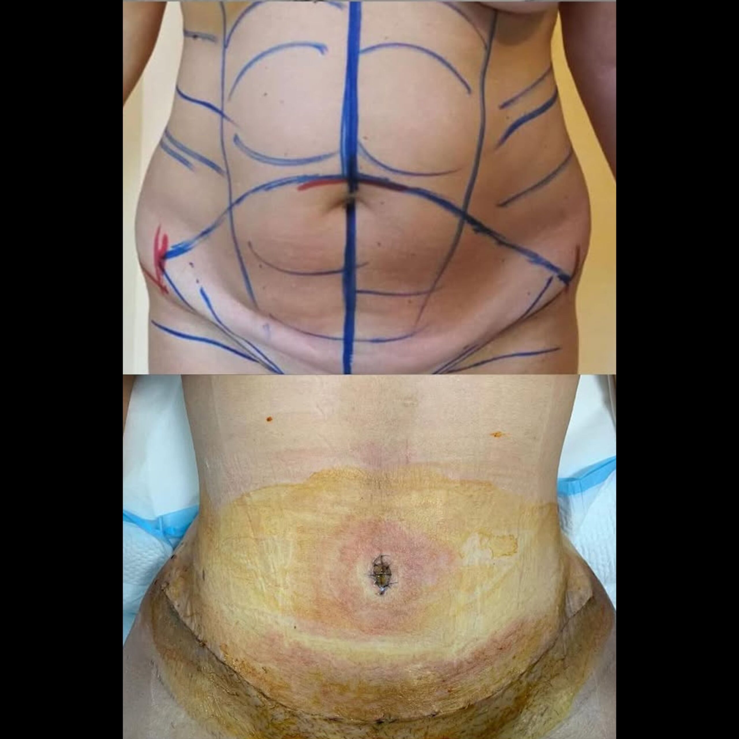 tummy tuck (1)