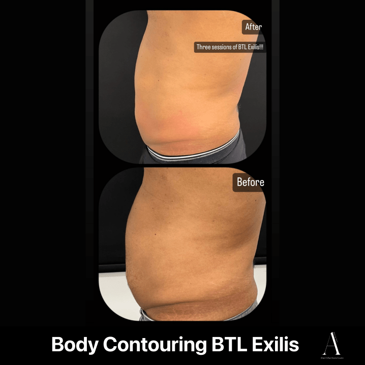 body contouring before after image