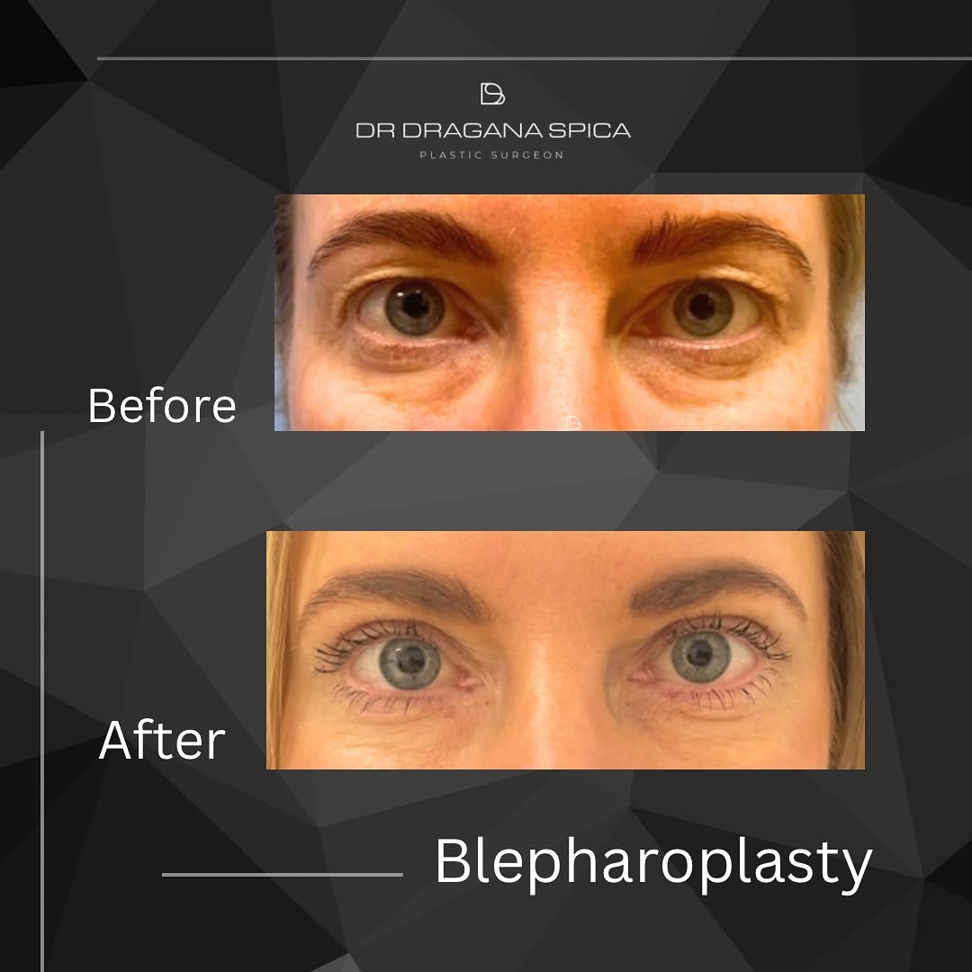 blepharoplasty 2