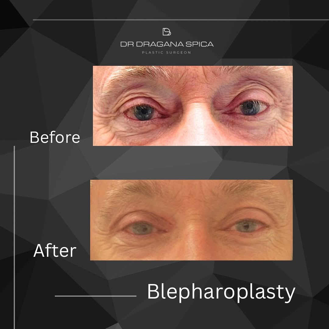 blepharoplasty 3