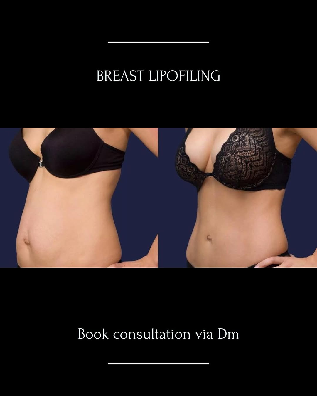 breast lipofiling 1