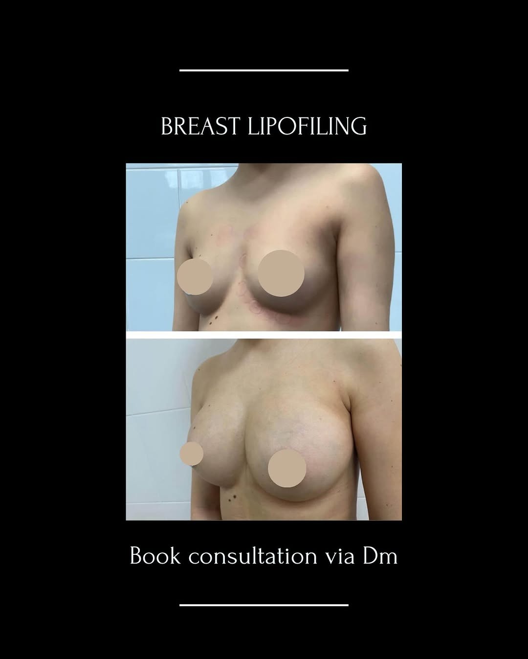 breast lipofiling 2