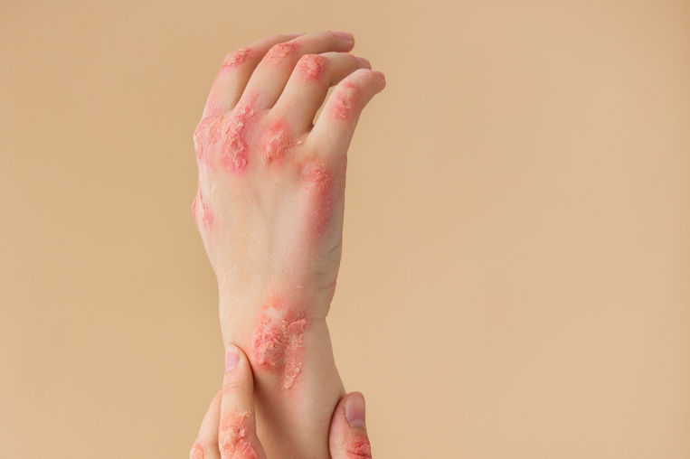 Customised Psoriasis Treatment Dubai