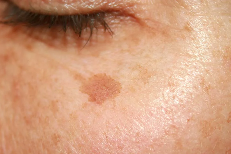 Skin Pigmentation Treatment Dubai