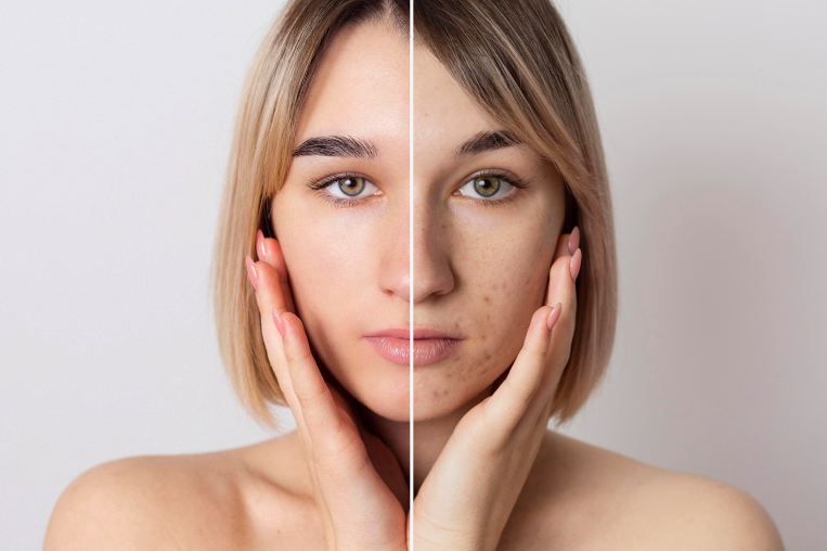 hyperpigmentation treatment in dubai