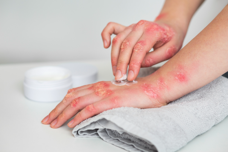 Urticaria Treatment in Dubai