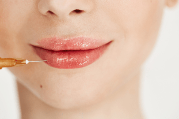 Lip Fillers