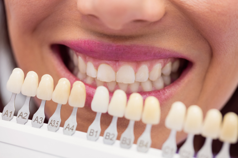 Best Dental Veneers Dubai