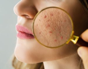 What is acne