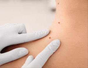 how much does mole removal cost
