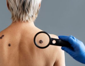 What is Mole Mapping -Aesthetics By King's