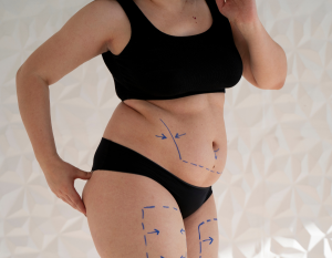 What is Liposuction - Aesthetics By King's