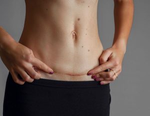Does Liposuction Surgery Leave Scars - Aesthetics by King's