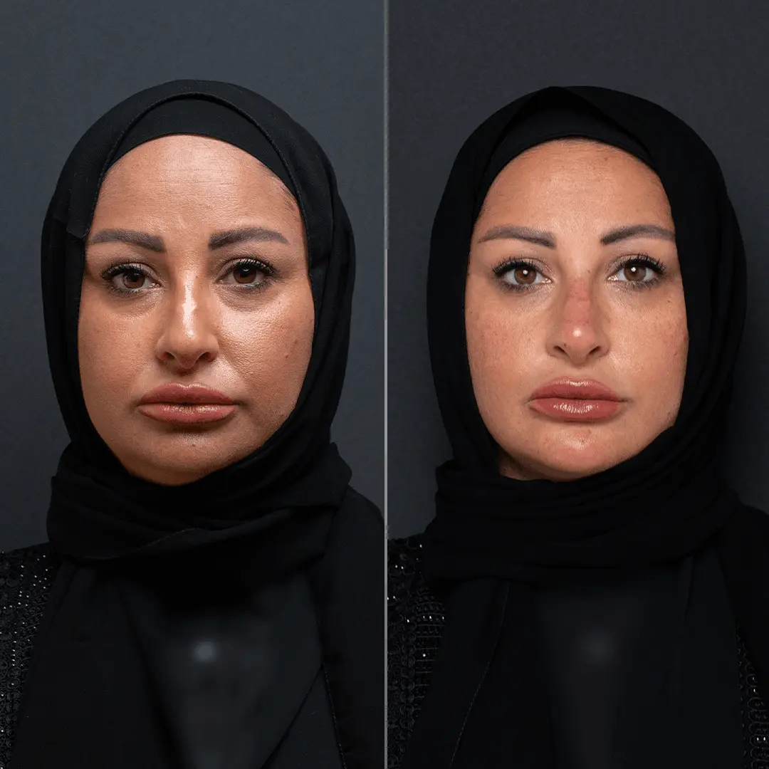 Before-After-1