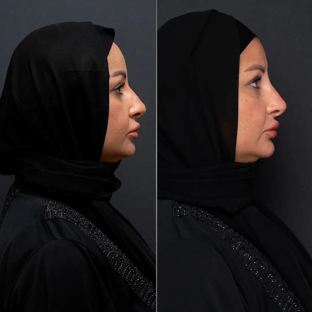 Before-After-2