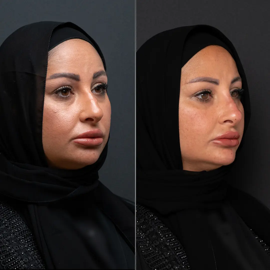 Before-After-3