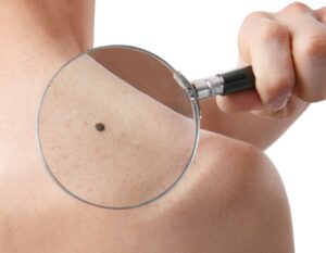 Different Types of Moles on Skin - Aesthetics by King’s